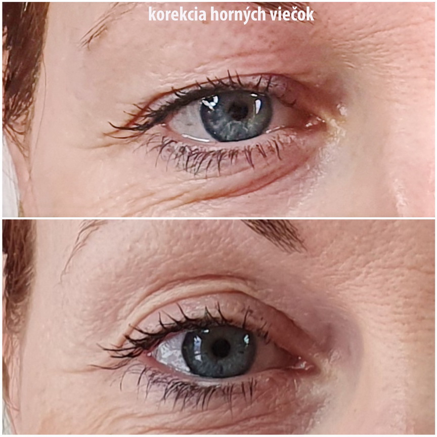 Korekcia očných viečok plazmovým lúčom PLEXR